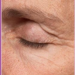 Thermage Before & After Patient #1590